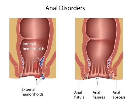 best of Fissure and treatment Anal