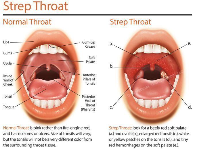 Oral sex and strep throat