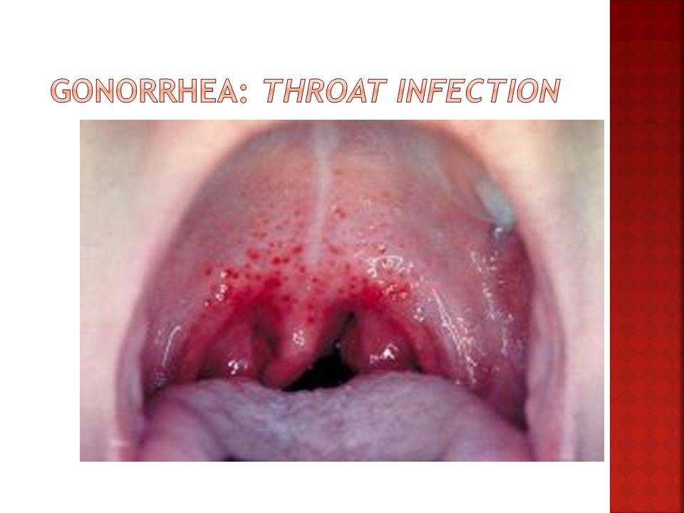 Champagne recomended Oral sex and strep throat