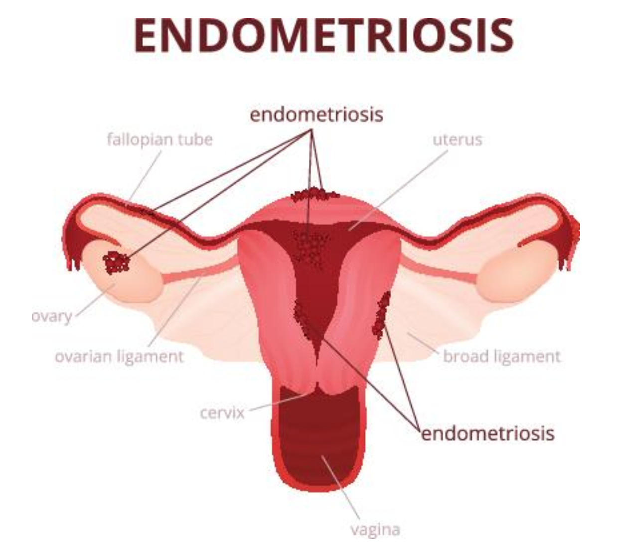 best of Orgasm Endometriosis and painful