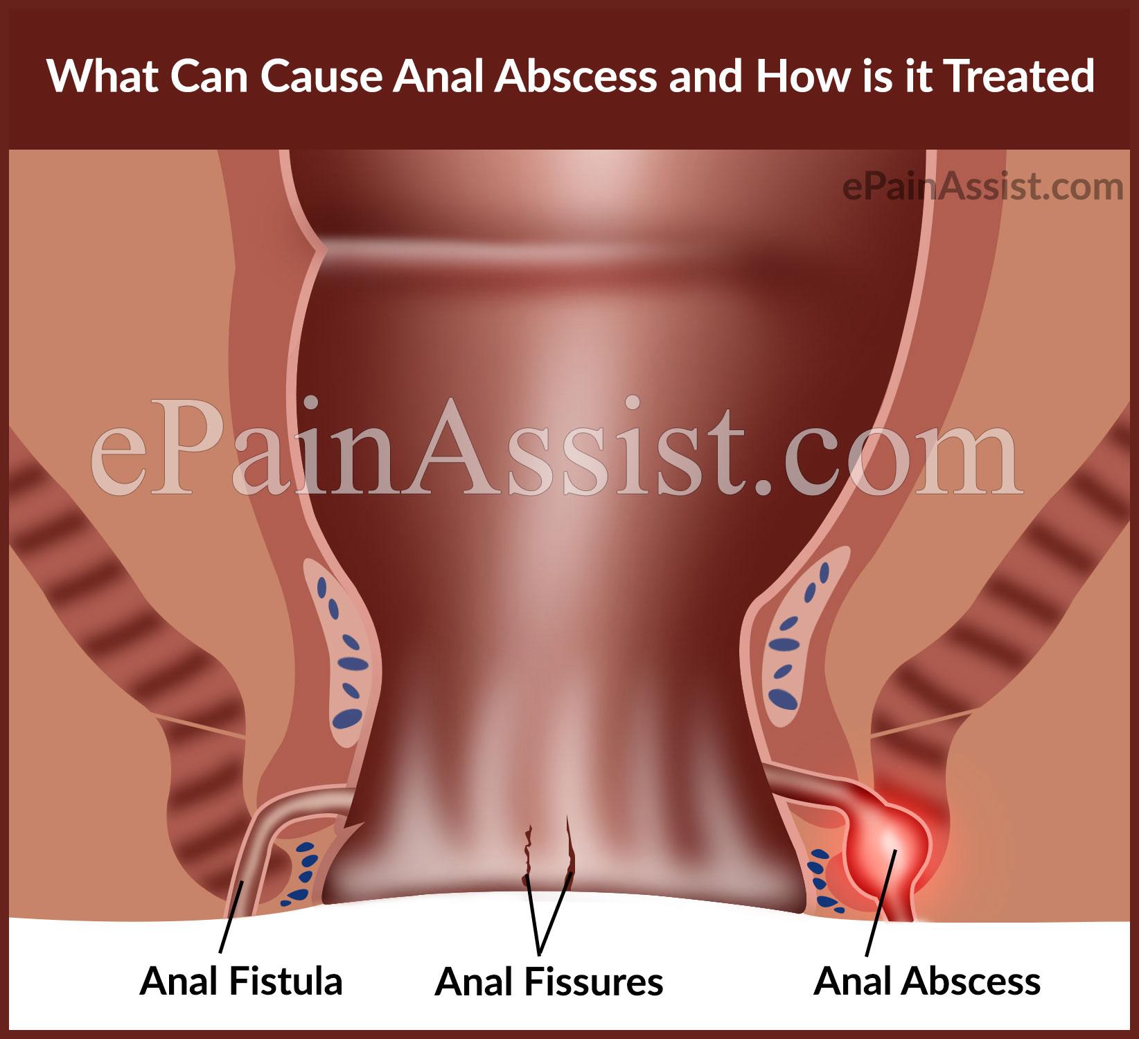 best of Treatment and Anal fissure