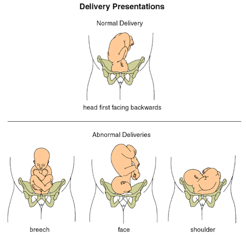 best of Breech Vaginal position birth