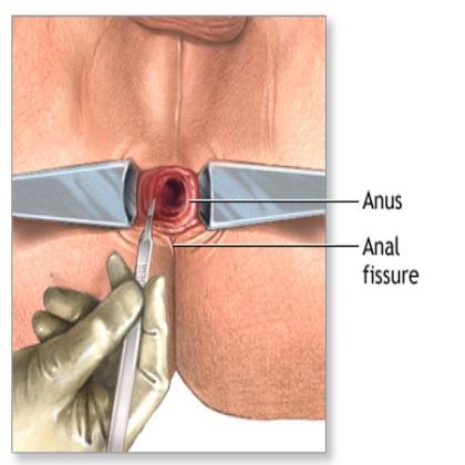 Crusher reccomend Anal fissure and treatment