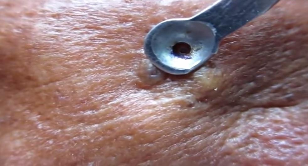Good D. recommendet popping fetish satisfy zit Cysts pimple