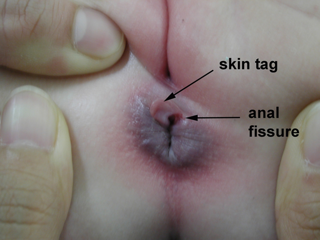 Anal fissure and treatment