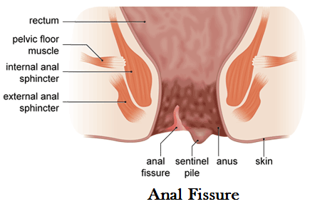 Rabbit reccomend Anal fissure and treatment