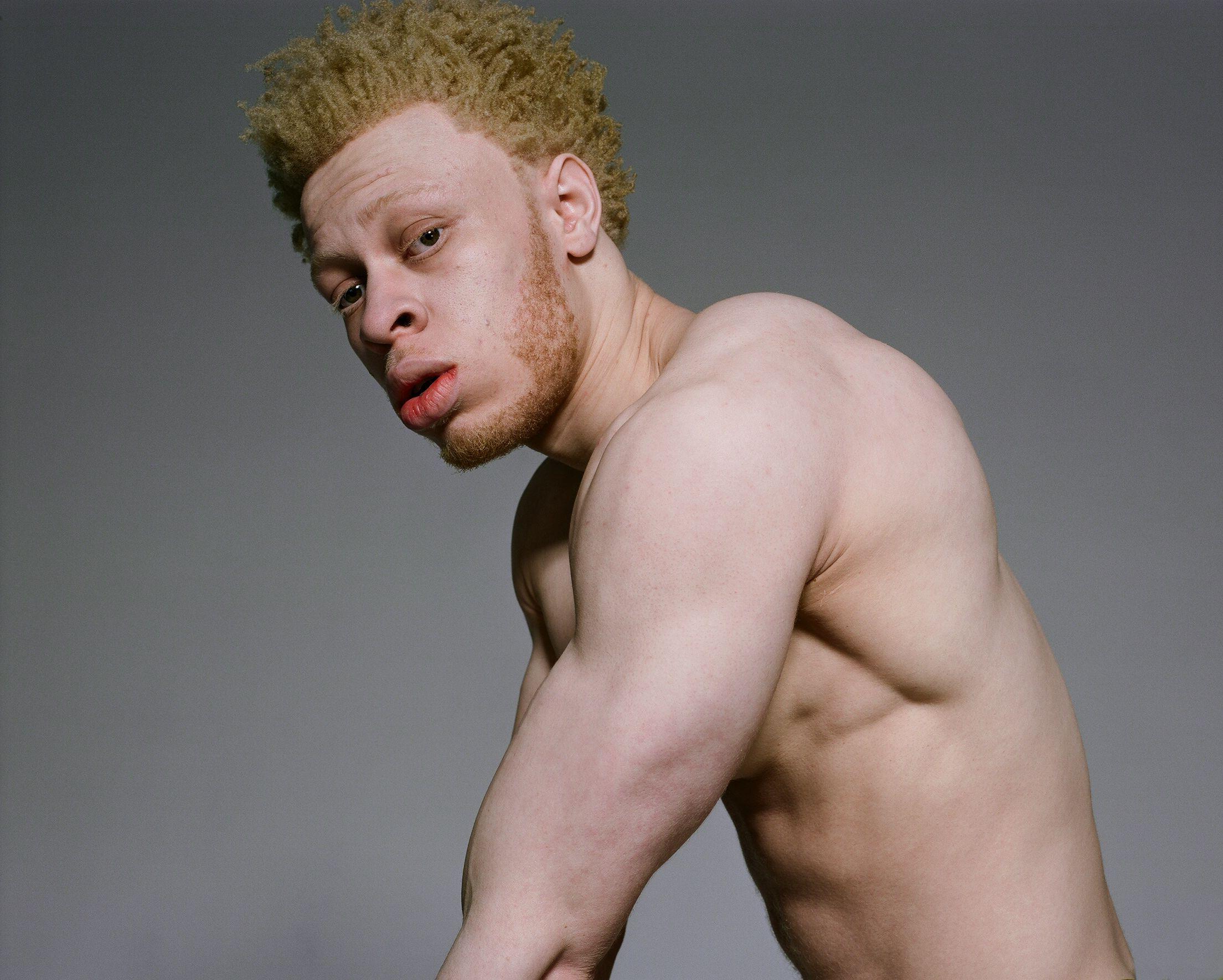 Nude Albino Girls Pics.