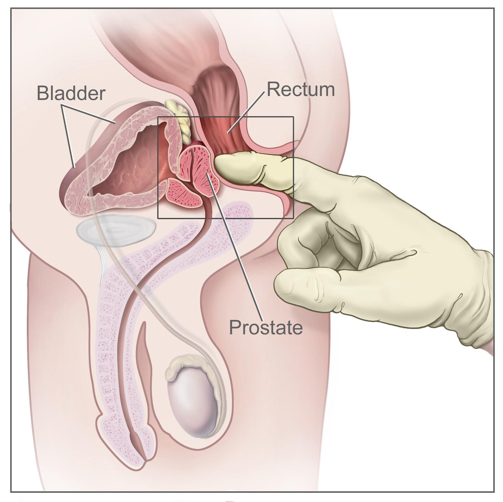 Sexual intercourse with prostatitis