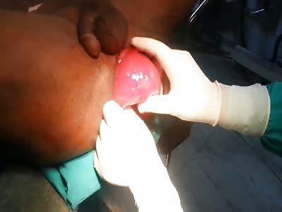 best of Anal balloon